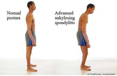 Ankylosing Spondylitis comparison